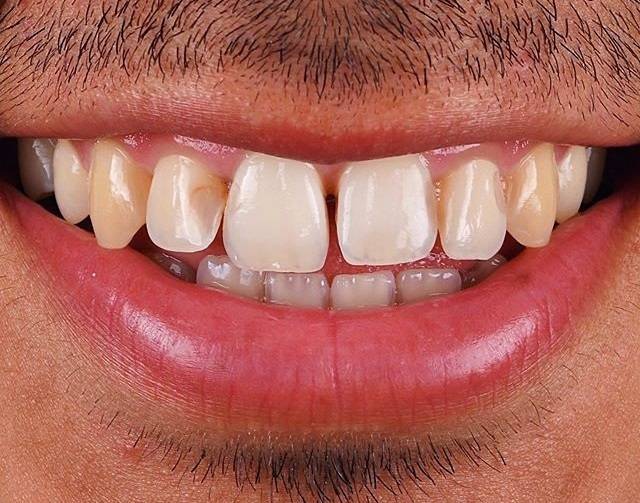 Invisalign