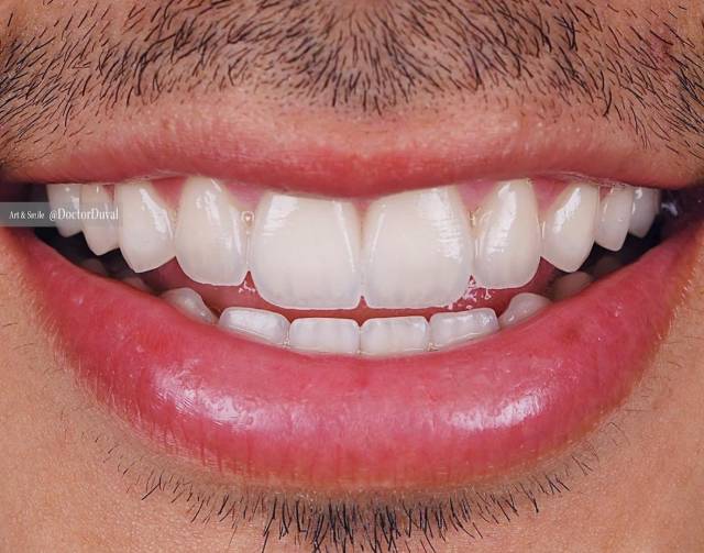 Invisalign