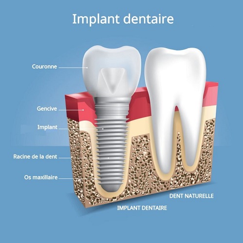 Implant Dentaire